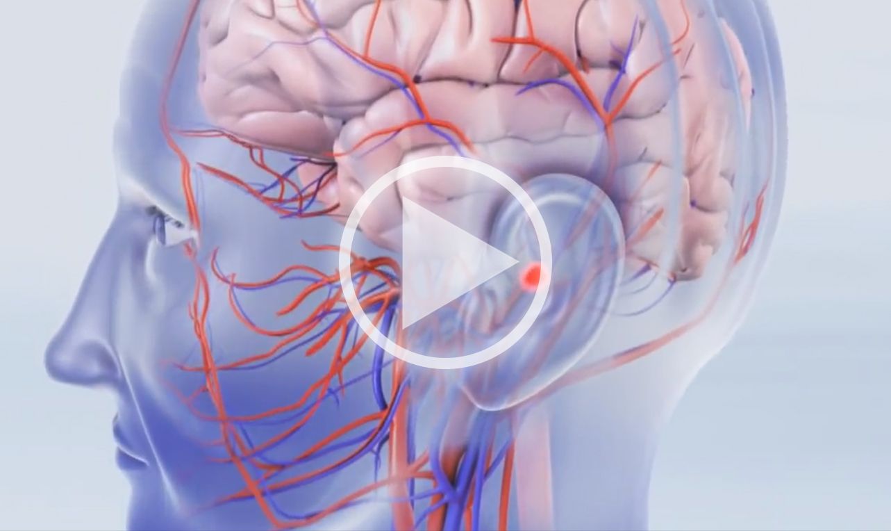 Atriumfibrillatie (AFib)