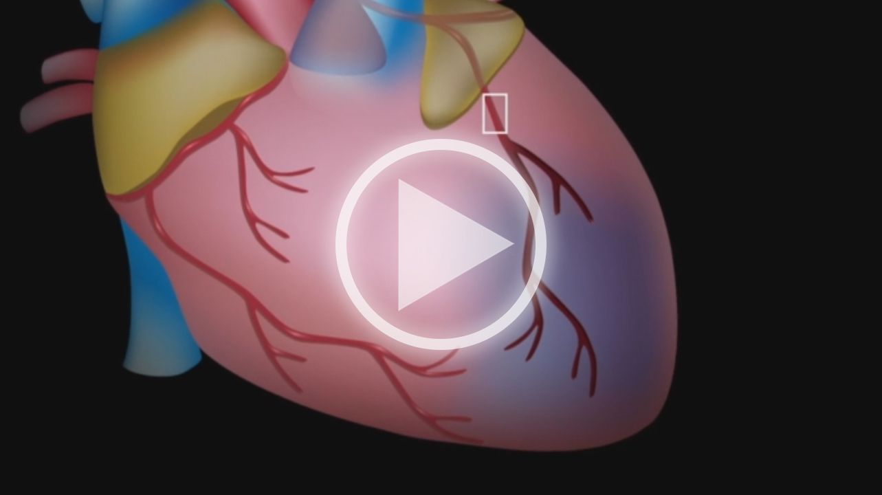 Myocardiaal Infarct